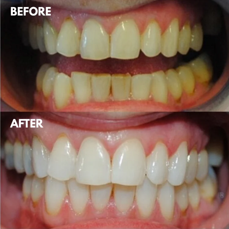 1 + 1 GRATIS IDAG | LumaSmile™ - Image 3