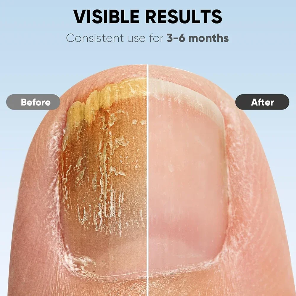 TILLFÄLLIGT 50% OFF | NailCure™ - Image 2