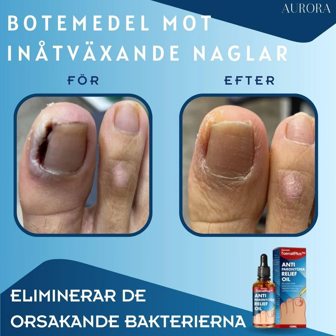 1 + 1 GRATIS IDAG | ToePerfect™ - Läker tånaglar och handnaglar - Image 4